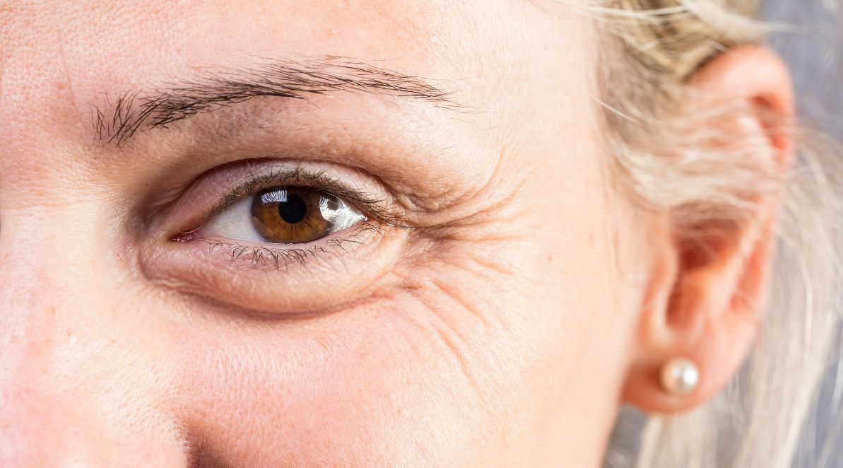 MANAGING UNDER EYE DRYNESS AND WRINKLES IN HOT WEATHER